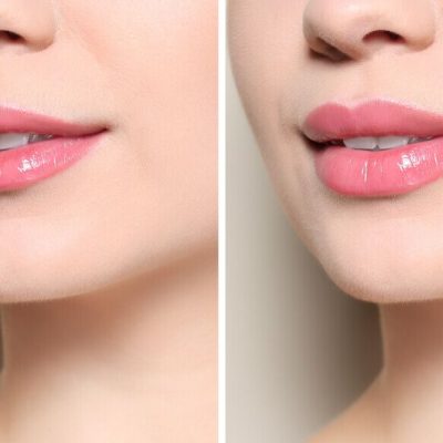 Southamptons Lip Filler Experts